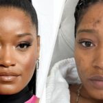 Keke Palmer Got Candid About Her Experience With Poly Cystic Ovarian Syndrome And Acne And This Is So Important